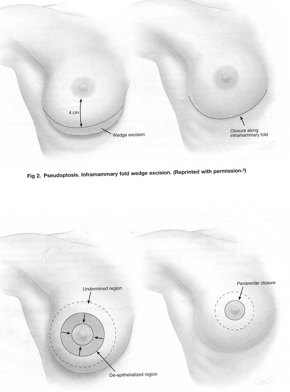 Micșorarea sânilor prin reducția pielii și repoziționarea complexului areolă-mamelon