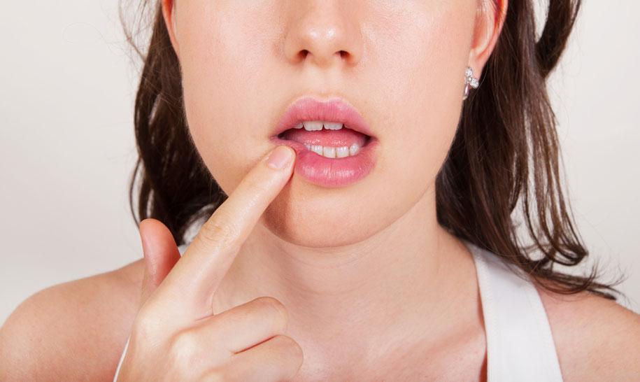 Adevărul despre herpesul bucal