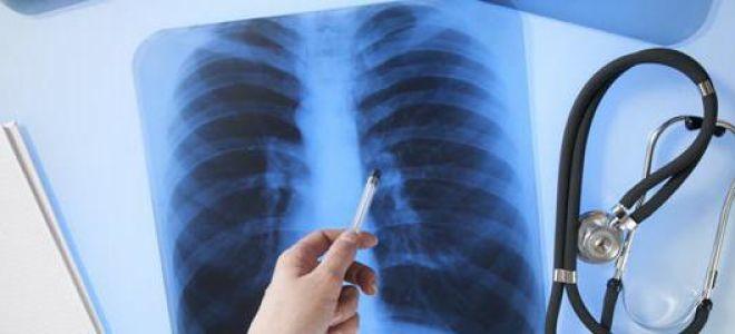Pneumonia - mit sau realitate? Ce spune pediatrul Mihai Stratulat
