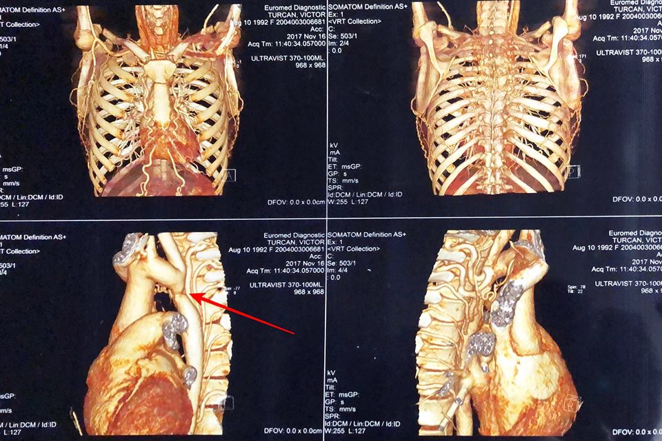 Vicu Țurcan are nevoie urgentă de ajutorul nostru. A fost diagnosticat cu viciu cardiac