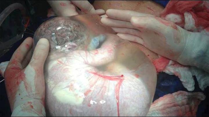 Fotografie cu un copil in sacul amniotic dupa cezariana