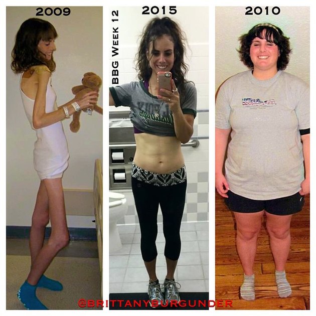 С 25 до 100: после анорексии девушка набрала 80 килограммов и снова похудела