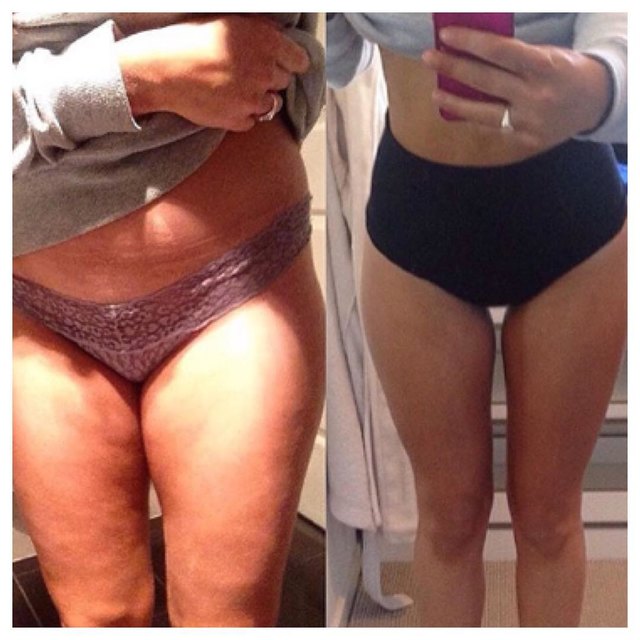 С 25 до 100: после анорексии девушка набрала 80 килограммов и снова похудела
