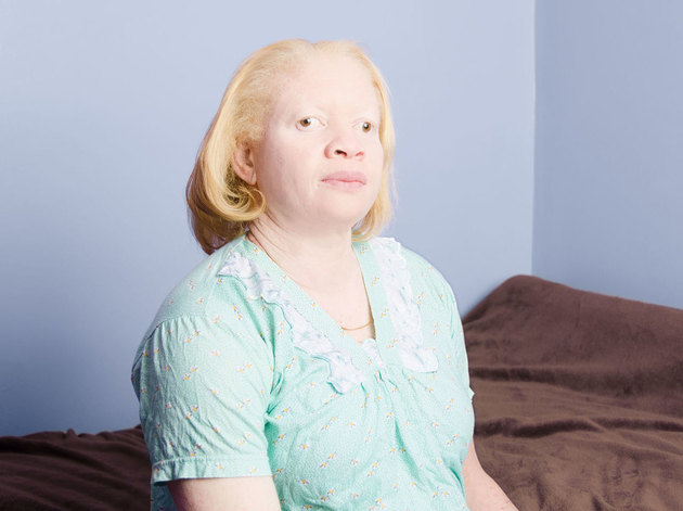Альбиносы стали героями фотопроекта, чтобы изменить отношение к себе